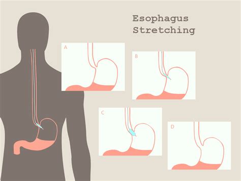 esophagus stretching